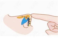 隆鼻手術(shù)后需要注意哪些事項