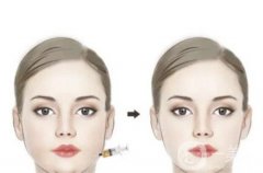 面部吸脂怎么樣，適合哪些人