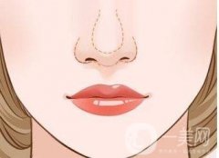 哪些因素與鼻部矯正手術(shù)的費用相關(guān)？