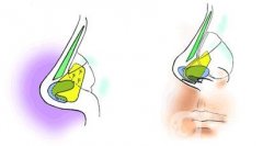 哪些情況下適合進(jìn)行鼻孔縮小手術(shù)呢？