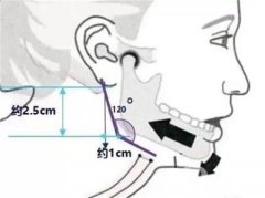 娜綺麗假體隆胸有哪些優(yōu)勢(shì)？