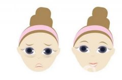 內(nèi)切眼袋手術(shù)是否會(huì)對(duì)視力有影響