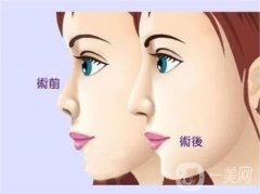 膨體隆鼻后如何加速軟化