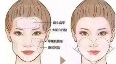 切眉術(shù)后的護(hù)理與注意事項(xiàng)