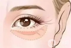 去除眼袋術后的注意事項有哪些