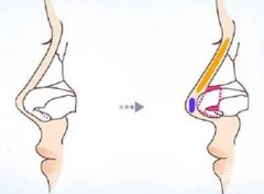 如何應(yīng)對(duì)膨體隆鼻后的效果不理想？