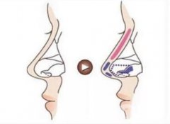 鼻頭縮小手術(shù)的優(yōu)勢及是否會(huì)反彈