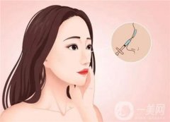 鼻綜合有后遺癥嗎？要注意哪些事項