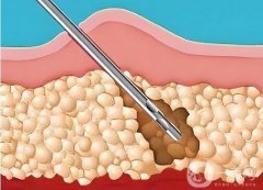 杭州正規(guī)醫(yī)院抽脂肪要多少錢？杭州正規(guī)整形醫(yī)院吸脂收費(fèi)揭曉~