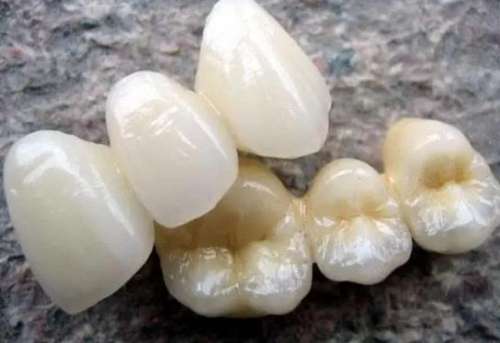 烤瓷牙套價(jià)格曝光：如何根據(jù)需求找到適合自己的價(jià)格？