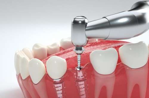 種植一顆牙需要多少錢？詳細(xì)解析牙齒修復(fù)費(fèi)用