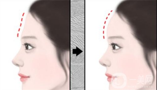 天津注射雙美膠原蛋白多少錢