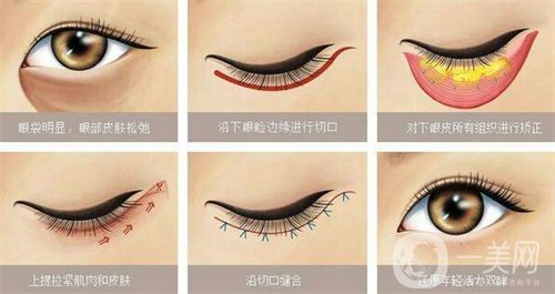 天津醫(yī)科大學眼科醫(yī)院做眼袋果如何?價格價目表2020年全新公布