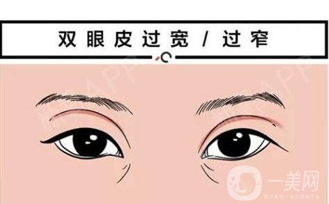 韓式*開眼角價(jià)格 韓式*開眼角多少錢？